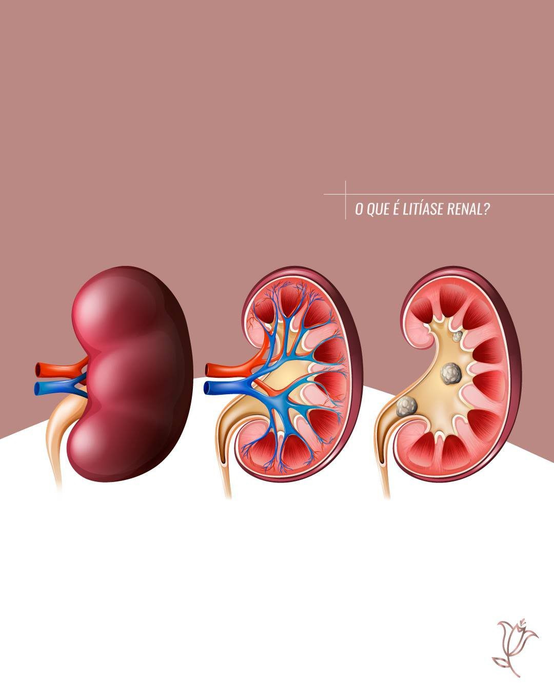 o que é litíase renal?