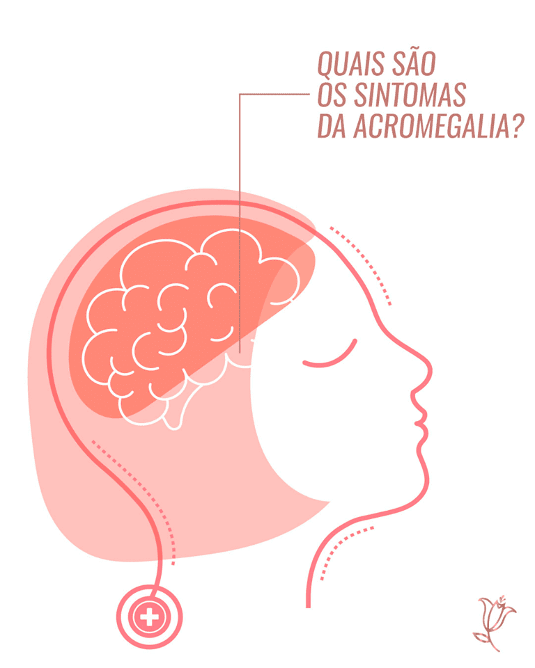 quais são os sintomas da acromegalia?