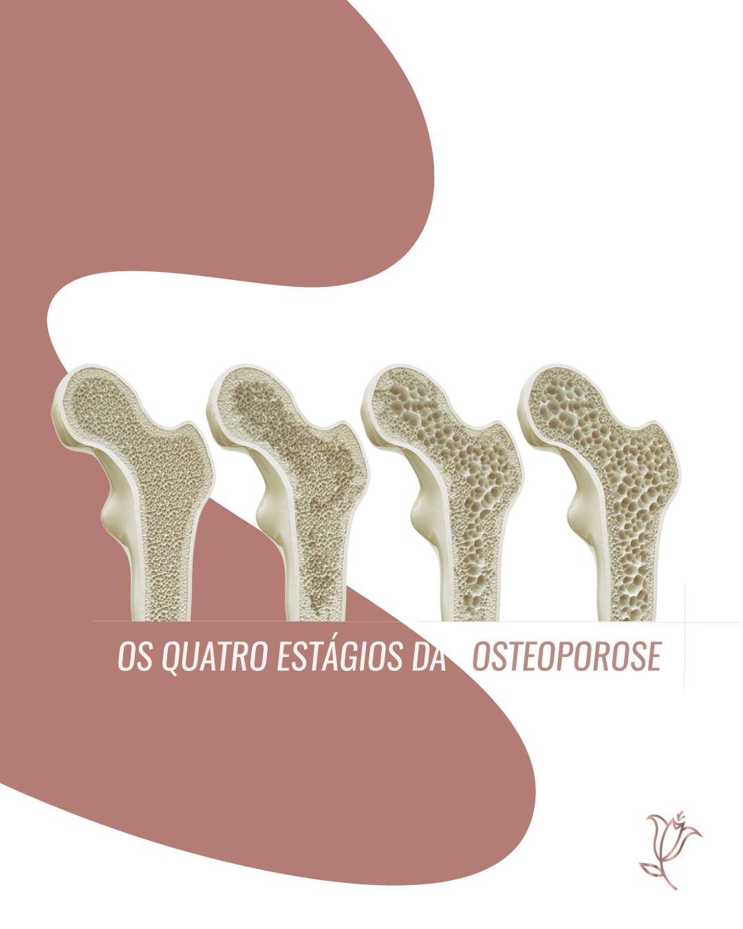 os quatros estágios da osteoporose